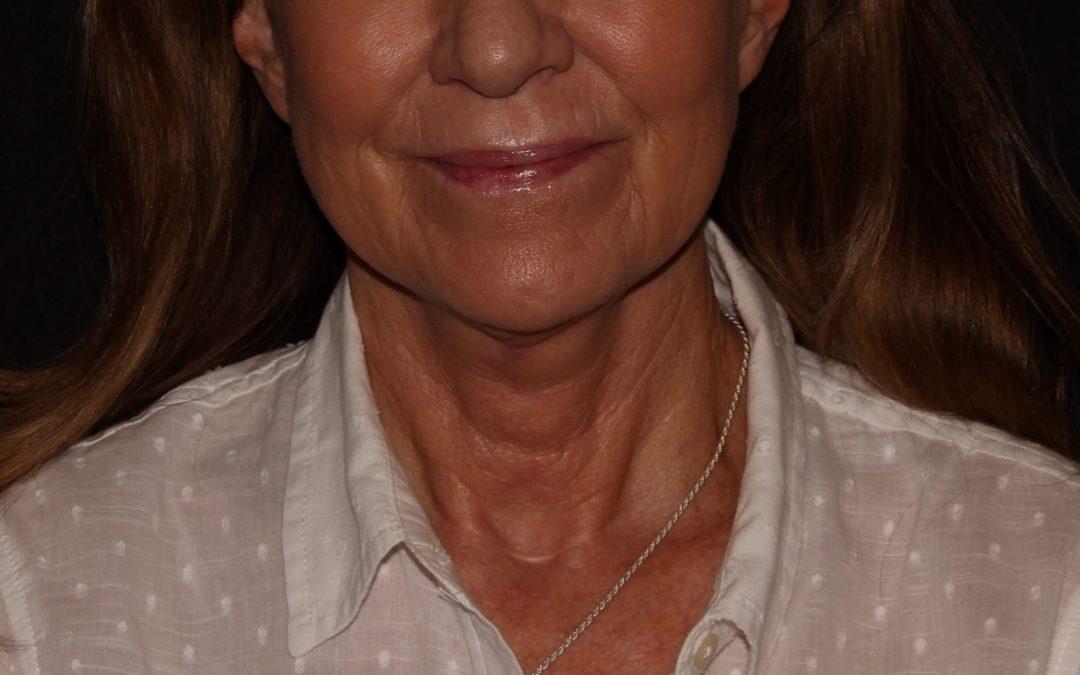 Face Lifts and Neck Lifts in Las Vegas