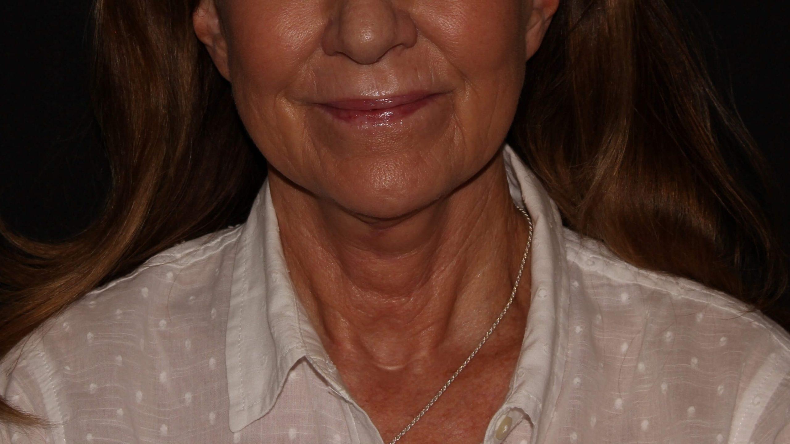 Close-up view of a woman's neck and chin area, showcasing smooth skin and a subtle smile. She is wearing a light-colored blouse with a collar, and a delicate necklace is visible around her neck. The background is softly blurred, emphasizing her facial features and the elegance of her attire. This image reflects a warm and approachable demeanor, suitable for articles related to beauty, skincare, or personal wellness.