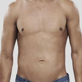 Gynecomastia in Las Vegas, NV