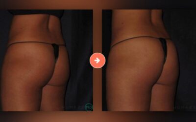 Radiesse & Bellafill Nonsurgical Butt Lift Las Vegas