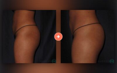 Get a Fuller, More Defined Butt with a Nonsurgical Butt Lift in Las Vegas