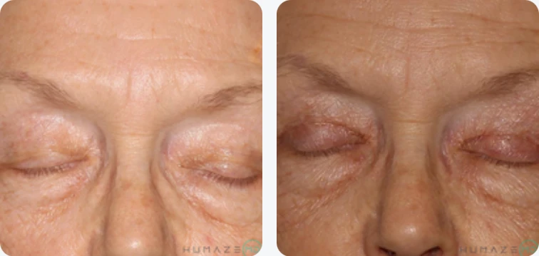 Close-up image of a person's eyes, showcasing before and after results of a cosmetic treatment. The left side displays visible signs of aging, including fine lines and wrinkles around the eyelids. The right side illustrates a smoother, rejuvenated appearance with reduced wrinkles, highlighting the effectiveness of the treatment. This image emphasizes the transformation achieved through cosmetic procedures, appealing to individuals seeking anti-aging solutions.