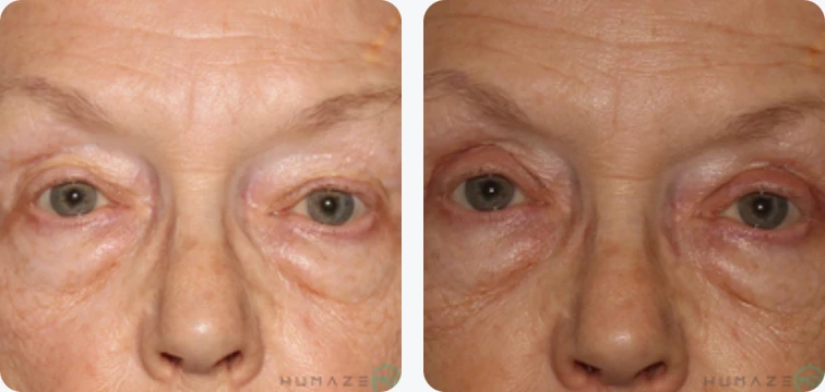 Before and after images showing the effects of an eye rejuvenation treatment on a mature individual. The left side displays visible signs of aging, including wrinkles and sagging skin around the eyes, while the right side illustrates a smoother, firmer appearance post-treatment. This transformation highlights the potential benefits of cosmetic procedures aimed at reducing signs of aging and enhancing eye appearance. The images emphasize the effectiveness of the treatment in achieving a more youthful look.