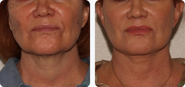 Before and after photo showcasing the effects of a cosmetic treatment on a woman's facial skin. The left side displays visible signs of aging, including fine lines and sagging skin, while the right side illustrates a smoother, firmer appearance post-treatment. The image highlights the transformative results of skin rejuvenation techniques, emphasizing improved skin texture and contour. Ideal for educational purposes in dermatology or aesthetic medicine, this visual aids in understanding the benefits of cosmetic procedures.