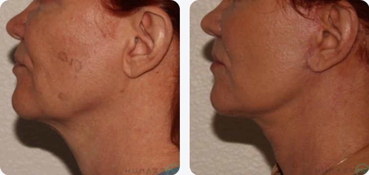Profile comparison of two individuals showing the difference in jawline and neck contour. The left side features a softer jawline and fuller neck, while the right side displays a more defined jawline and slimmer neck. This image highlights the effects of cosmetic procedures or natural aging on facial structure. Ideal for discussions on aesthetic treatments, facial rejuvenation, and the impact of aging on appearance.