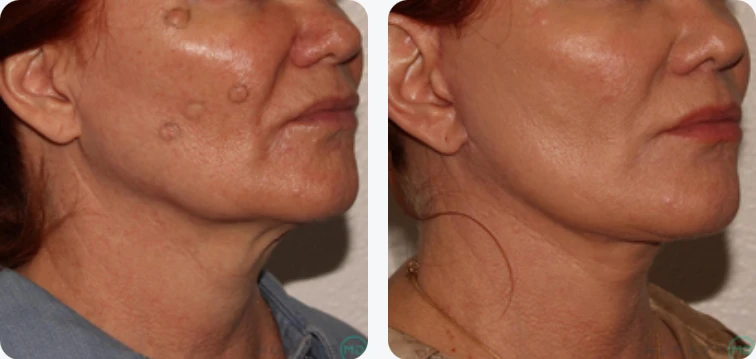 Before and after images of a woman's neck showcasing the effects of a cosmetic procedure. The left side displays visible signs of aging, including sagging skin and wrinkles, while the right side demonstrates a smoother, firmer neck contour post-treatment. The images highlight the improvement in skin texture and overall appearance, emphasizing the benefits of cosmetic enhancements for rejuvenating the neck area. Suitable for individuals considering aesthetic procedures, this visual comparison illustrates the potential results and effectiveness of such treatments.