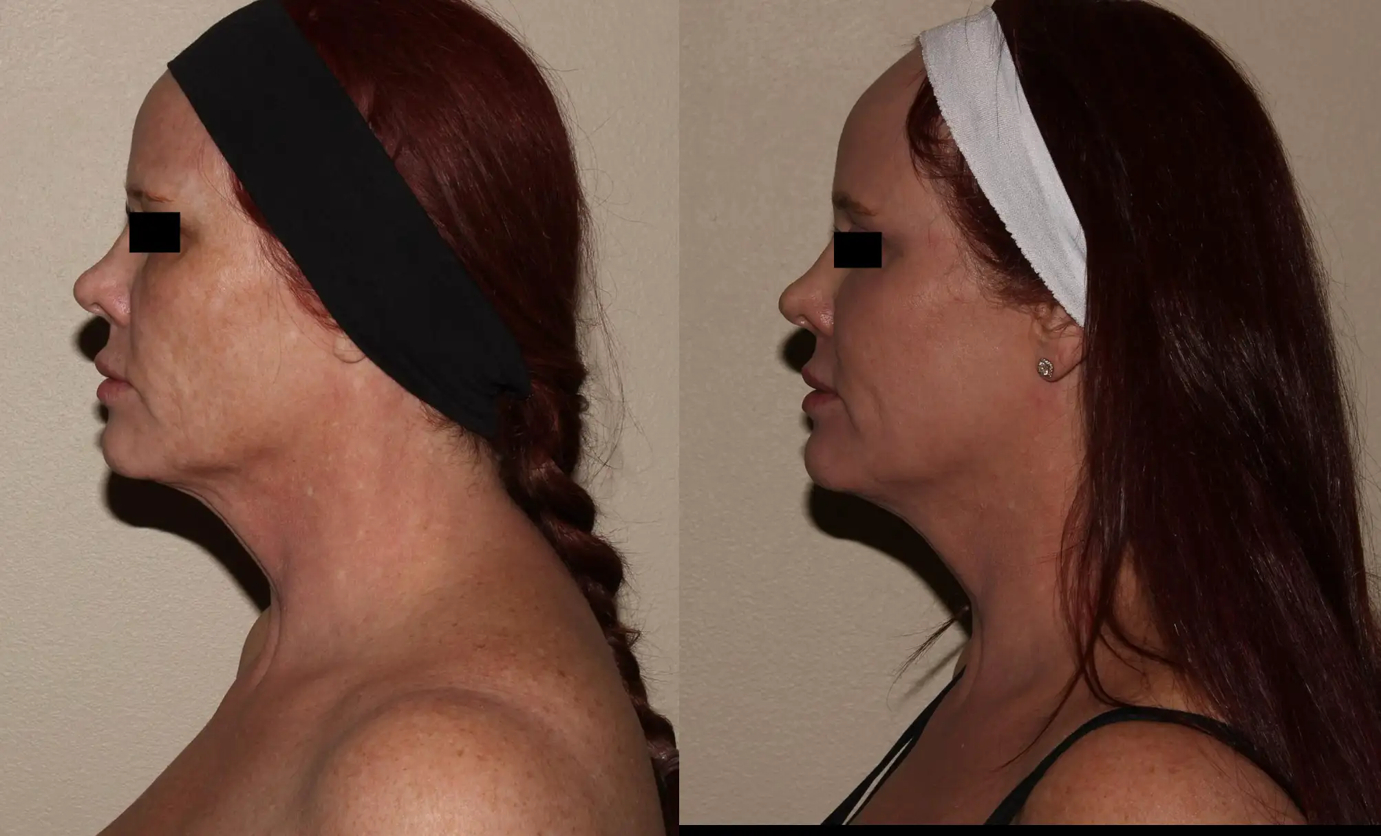 Side profile comparison of a woman with long red hair styled in a braid and wearing a black headband on the left and a white headband on the right. The image showcases her neck and facial structure from both angles, highlighting the differences in appearance. The background is neutral, ensuring focus on the subject. This visual can be useful for discussions on hairstyle choices, profile aesthetics, or beauty trends.