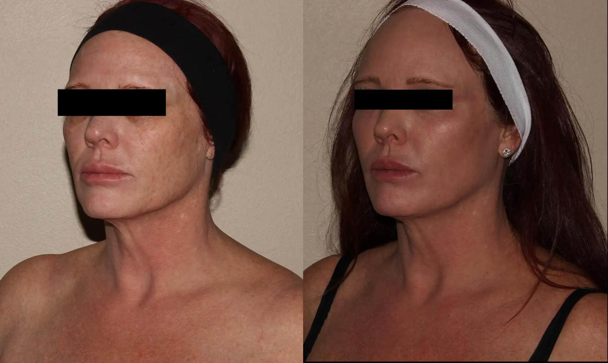 Before and after images showcasing the effects of a cosmetic treatment on a woman's facial appearance. The left side displays the woman's profile with a shorter hairstyle and a black headband, while the right side features her with longer hair and a white headband. Both images highlight changes in skin tone and texture, emphasizing the results of the treatment. The background is neutral, ensuring focus on the subject's features. This comparison is useful for individuals considering similar cosmetic procedures.