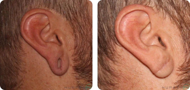 Close-up image showing the side profile of two human ears, highlighting differences in ear shapes and sizes. The left ear appears smaller and has a distinct shape, while the right ear is larger and more rounded. Both ears are set against a neutral background, emphasizing their anatomical features. This image can be used for educational purposes related to ear anatomy, hearing health, or cosmetic procedures.