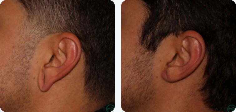 Side-by-side comparison of two male profiles showcasing different ear shapes and haircuts. The left image features a shorter hairstyle and a more prominent ear, while the right image displays a longer hairstyle with a less noticeable ear. Both images highlight the variations in individual facial features and hairstyles, emphasizing personal grooming choices. This visual illustrates the differences in ear anatomy and styling preferences among men.