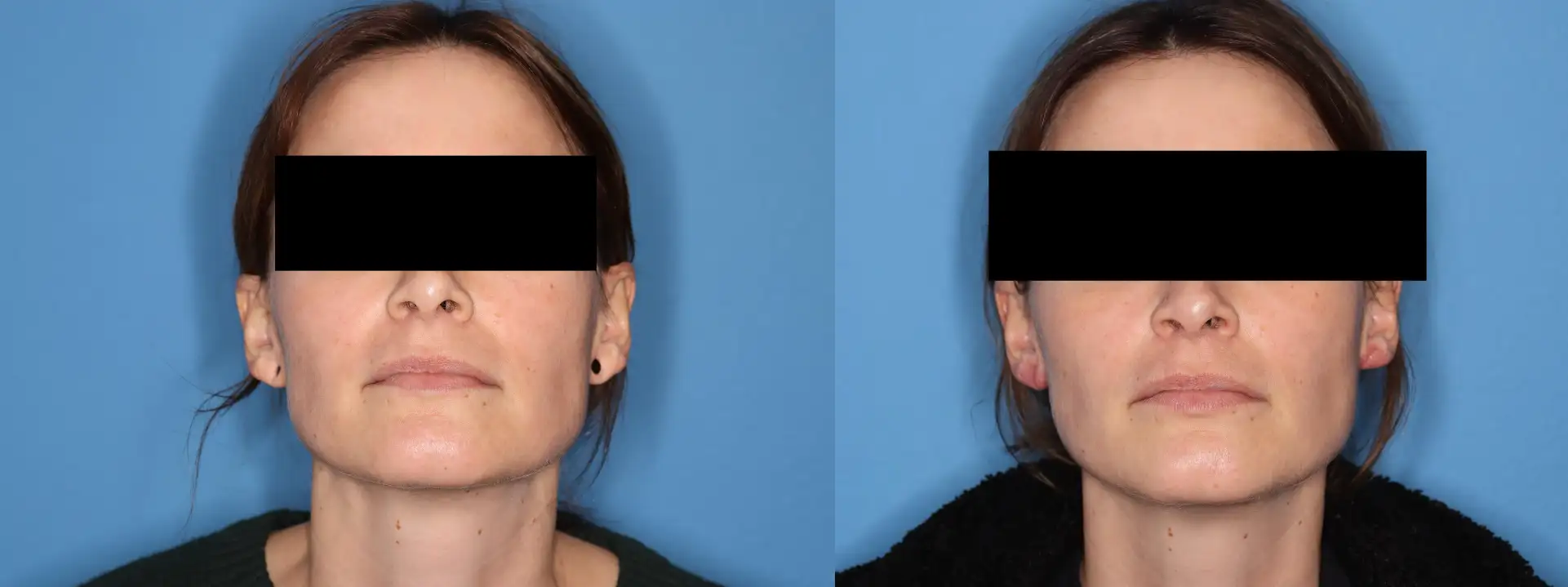 Image shows two side-by-side portraits of a woman with her hair pulled back, set against a blue background. The left portrait features her with a neutral expression, while the right portrait shows her smiling. Both images have black bars over her eyes for privacy. This visual comparison highlights the difference in facial expressions, which may be used to discuss topics related to emotional expression, photography techniques, or psychological studies. The image is relevant for discussions on non-verbal communication or facial recognition.