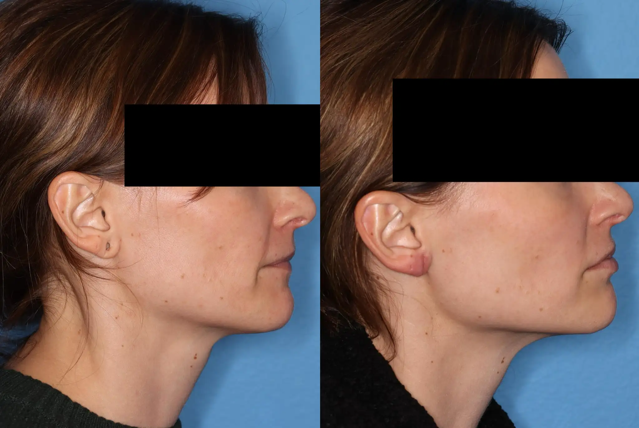 Before and after profile images of a woman showing the results of a cosmetic procedure. The left side displays her original profile, highlighting her jawline and neck. The right side illustrates the enhanced contour of her jaw and neck post-procedure. Both images are taken against a solid blue background, ensuring focus on the facial changes. The woman’s eyes are obscured for privacy. This visual comparison effectively demonstrates the impact of the treatment on facial aesthetics, making it relevant for individuals considering similar cosmetic enhancements.