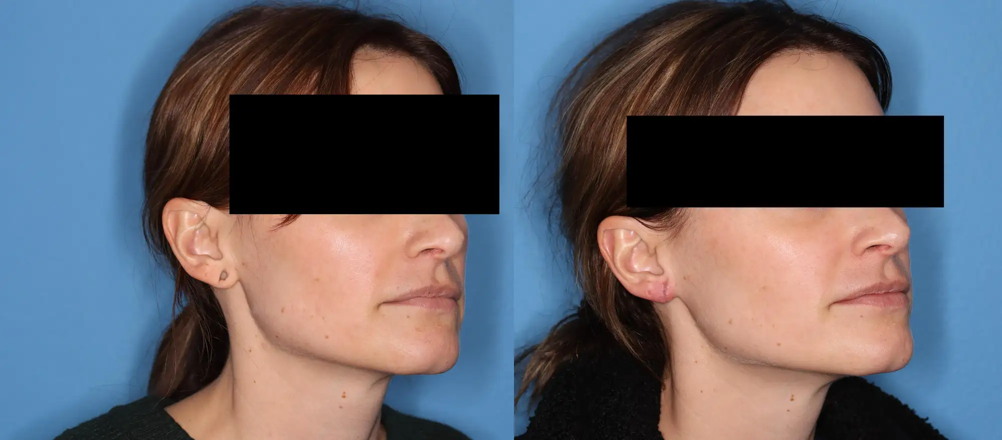 Profile view of a woman showing her face from both the left and right sides against a blue background. The image highlights the contours of her jawline and ears, demonstrating a cosmetic procedure or treatment. The woman has medium brown hair styled down, and her facial features are unobscured except for black bars covering her eyes for privacy. This comparative angle emphasizes the changes in facial aesthetics, commonly used in before-and-after analyses in cosmetic surgery discussions.