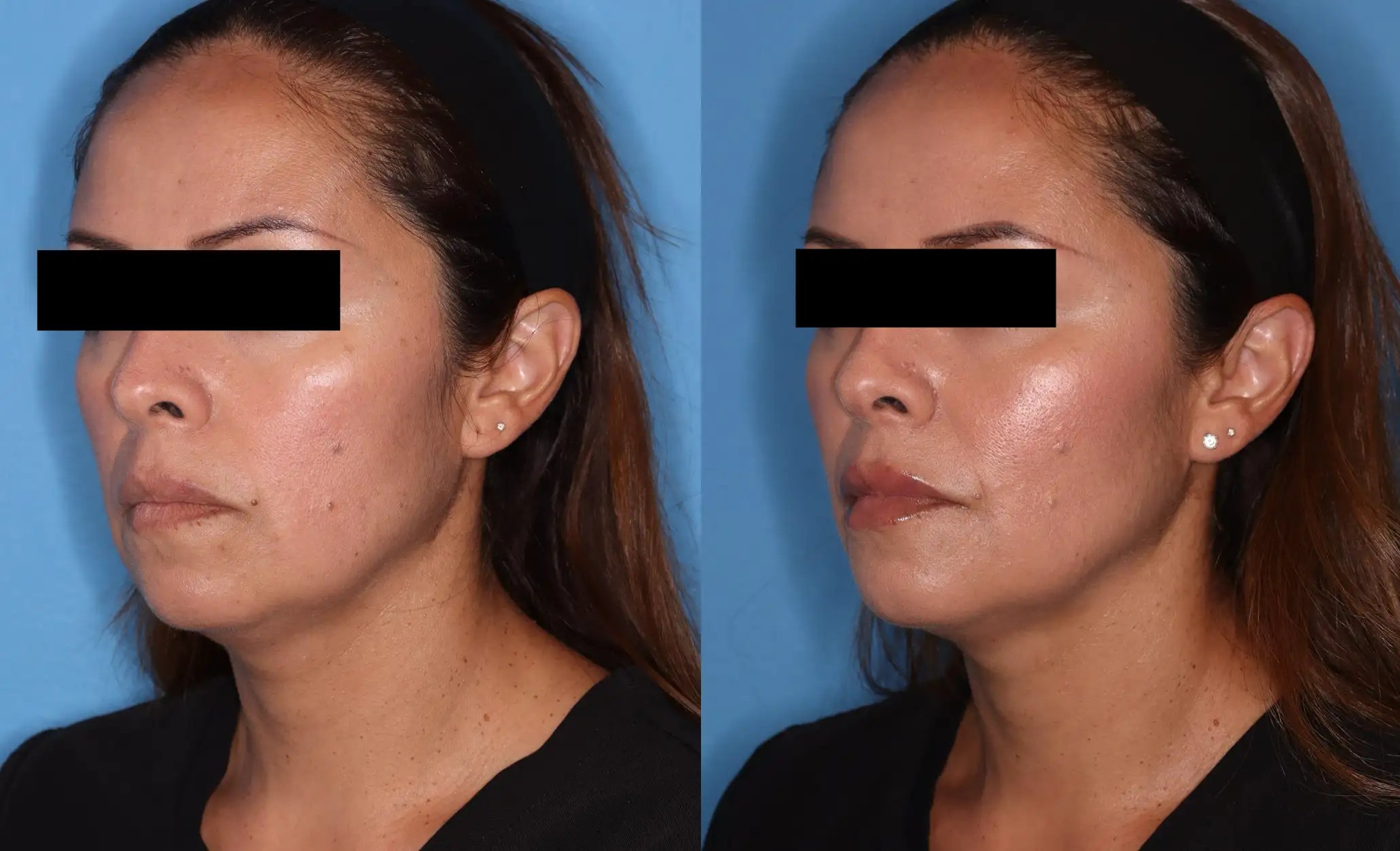 Profile view of a woman before and after a cosmetic procedure, showcasing changes in facial structure and skin texture. The left side displays the woman's appearance prior to treatment, while the right side highlights improvements post-procedure. The background is a solid blue, emphasizing the subject's features. The woman has long hair and is wearing a black top. This image illustrates the effects of cosmetic enhancements, providing a visual comparison for potential clients interested in similar treatments.