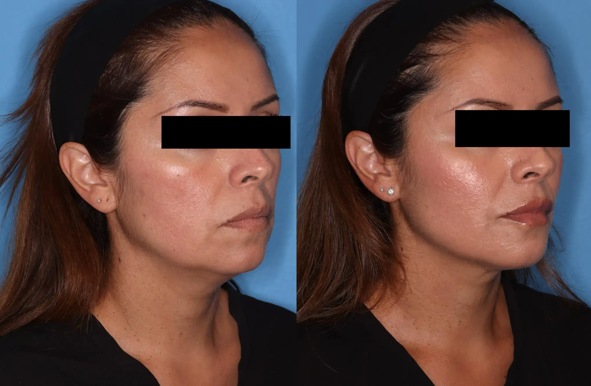 Before and after profile images of a woman showcasing the results of a cosmetic procedure. The left image displays her facial profile prior to treatment, highlighting a more pronounced jawline and less defined cheekbones. The right image illustrates the enhanced facial contours and improved symmetry following the procedure. Both images are set against a blue background, emphasizing the changes in her appearance. This visual comparison is useful for understanding the effects of cosmetic enhancements on facial aesthetics.