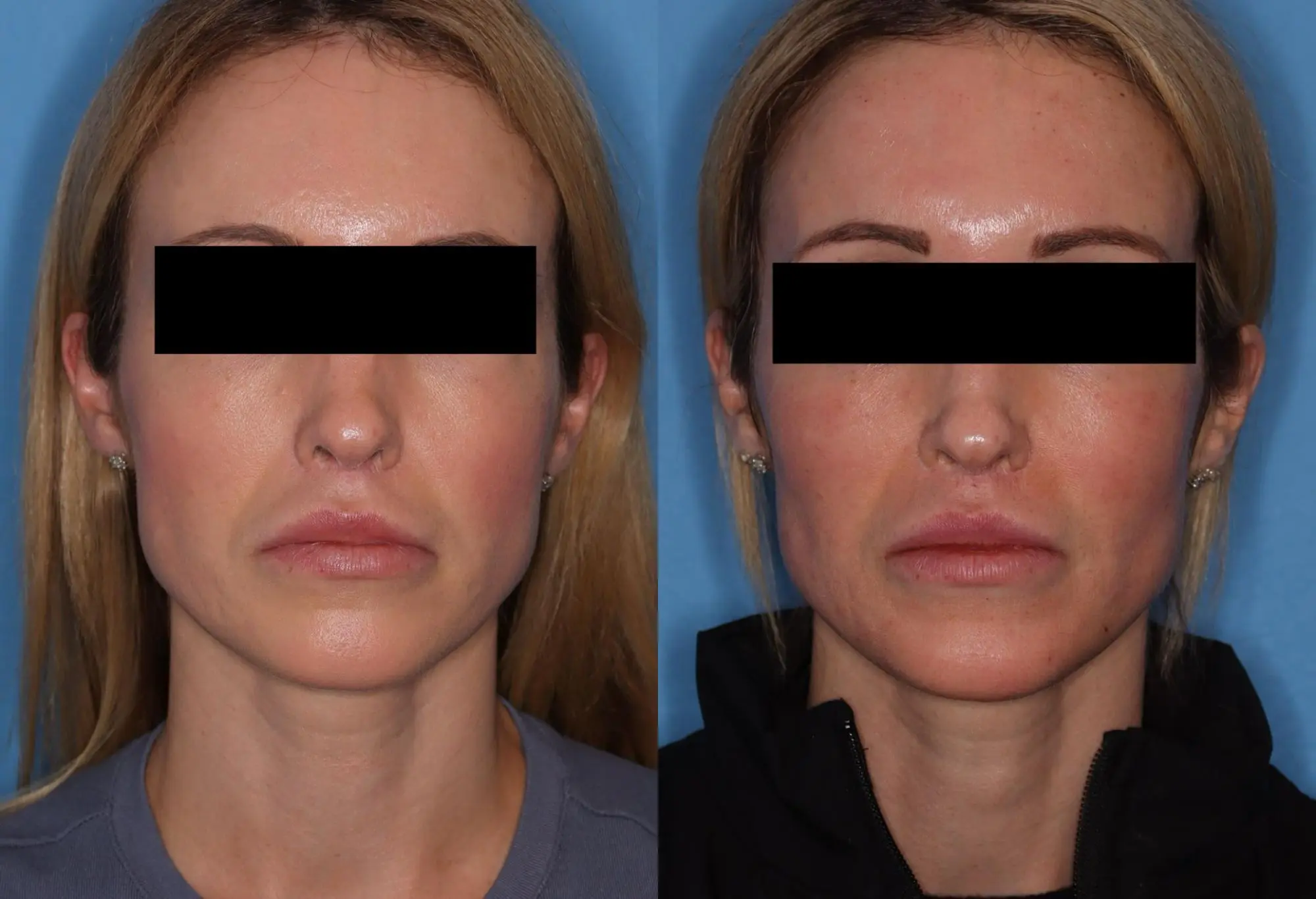 Before and after images showcasing facial cosmetic enhancements. The left side displays the original appearance, highlighting natural features with minimal makeup. The right side illustrates the results post-treatment, featuring enhanced contours and defined jawline. Both images emphasize the transformation while maintaining a natural look. The background is a solid blue, ensuring focus on the facial changes. This comparison serves as a visual reference for individuals considering cosmetic procedures, illustrating potential outcomes and the effectiveness of treatments available in the cosmetic industry.