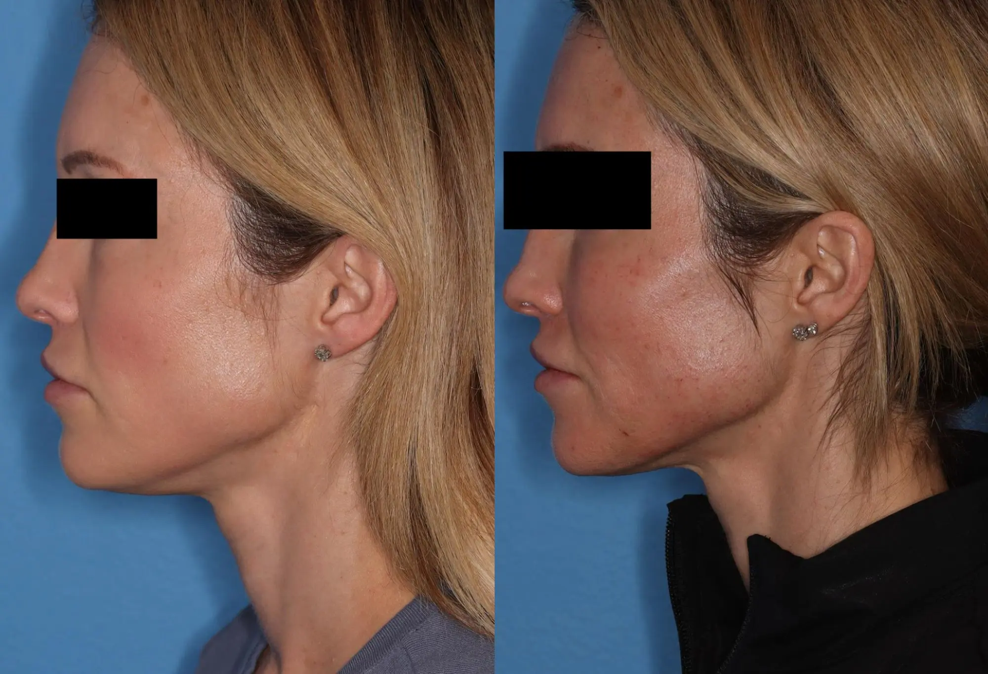 Before and after images showcasing the side profile of a woman, highlighting changes in facial structure and contour. The left side displays her appearance prior to treatment, while the right side shows her post-treatment look, emphasizing enhanced jawline definition and overall facial symmetry. The background is a solid blue, providing contrast to the subject's features. This image illustrates the effects of cosmetic procedures aimed at improving facial aesthetics.
