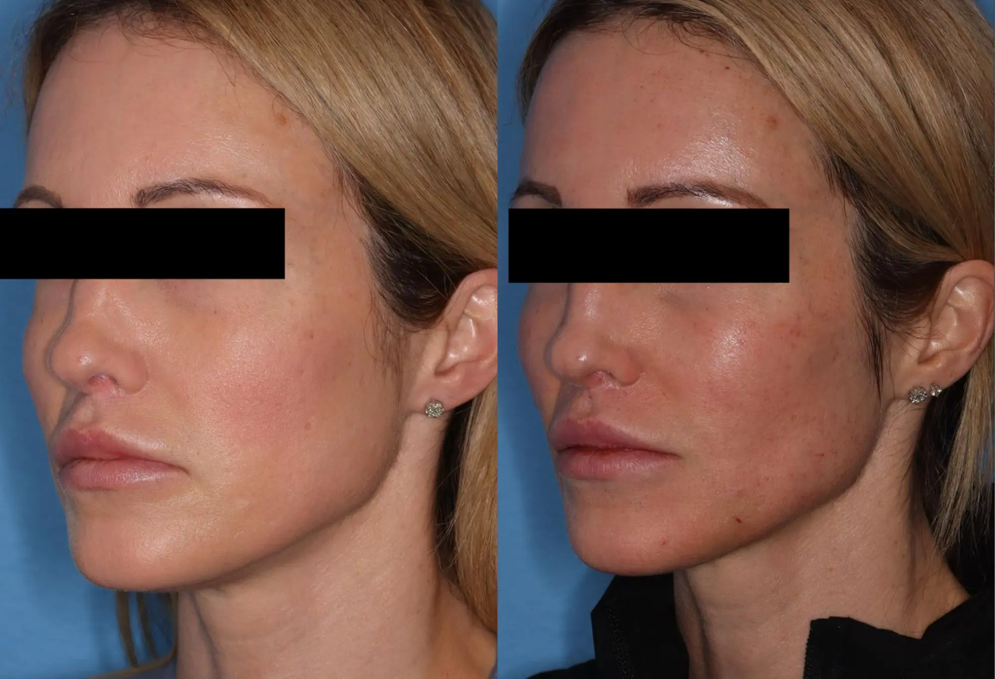 Before and after image showing the side profile of a woman who underwent aesthetic facial treatment. The left side displays her original appearance, highlighting natural features and skin texture. The right side showcases the results post-treatment, with enhanced facial contours and smoother skin, illustrating the effectiveness of the procedure. The background is a neutral color, allowing focus on the facial changes. This image serves as a visual reference for potential patients considering aesthetic procedures, emphasizing the transformative results achievable through professional treatment.