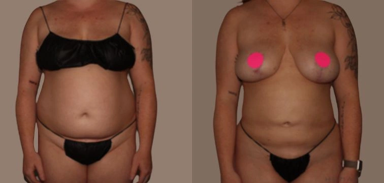 Image showing a person in a black bikini from the side and front views. The side view displays body contours and tattoos, while the front view highlights a specific area marked with a pink circle. This image may relate to discussions on body positivity, self-acceptance, or health awareness. It is essential for individuals to engage with diverse body types and promote inclusivity. The background is neutral, allowing the focus to remain on the subject.
