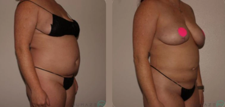 Before and after transformation showing a woman's body from the side view. The left side displays a rounded belly, while the right side shows a flatter abdomen. The woman is wearing black lingerie in both images, highlighting changes in body shape and fitness level. The background is neutral, allowing focus on the physical changes. This image represents a journey of health and fitness improvement.