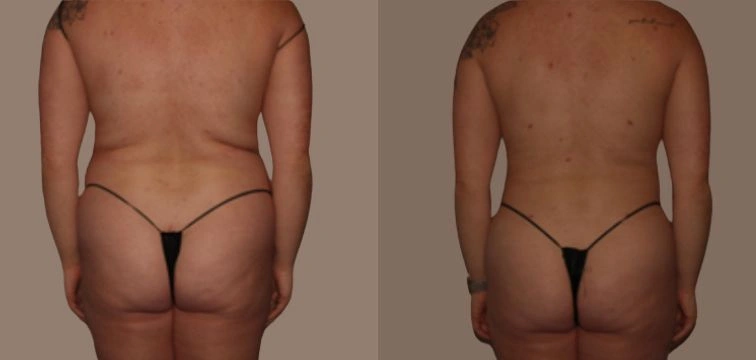 Image showing the back view of a person wearing a bikini-style swimsuit, highlighting body contours and skin texture. The left side displays the individual’s natural form, while the right side showcases a modified appearance. The background is neutral, emphasizing the subject. This image can be used in discussions about body positivity, personal transformation, or comparisons in body image. It serves as a visual representation of varying body shapes and the impact of different clothing styles on appearance.