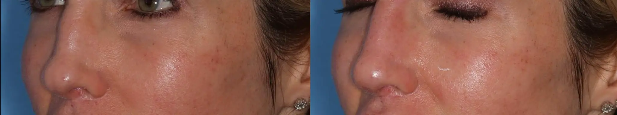 Close-up comparison of two women's faces, highlighting different facial features. The left side shows a profile view with visible earrings and hair texture, while the right side presents a frontal view focusing on the cheek and eye area. This image illustrates variations in facial structure and beauty aesthetics, useful for discussions on cosmetic procedures or beauty trends.