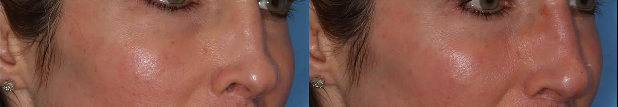 Close-up image showcasing two female faces side by side, highlighting features such as the eyes, nose, and ears. The left side displays a woman with a smooth complexion and dark hair, while the right side features a woman with a slightly textured complexion and medium-length hair adorned with a diamond earring. The background is a solid blue, emphasizing the facial details. This image can be used for discussions on facial anatomy, beauty standards, or cosmetic procedures.