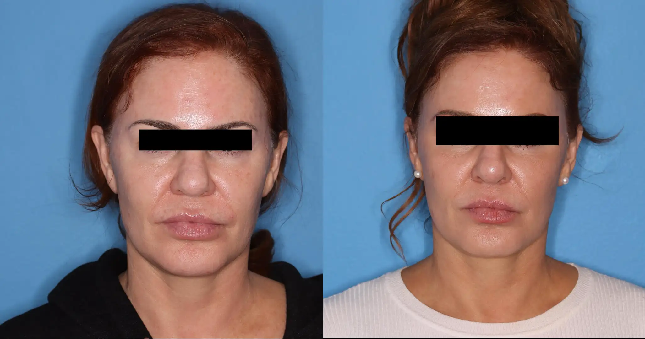 Before and after images showcasing the results of a facial rejuvenation treatment. The left side displays the patient's appearance prior to the procedure, highlighting signs of aging such as wrinkles and sagging skin. The right side presents the enhanced look post-treatment, demonstrating a smoother, more youthful complexion with improved skin tightness and definition. The background is a solid light blue, emphasizing the transformation. These images illustrate the effectiveness of the treatment in achieving a refreshed and revitalized facial appearance.