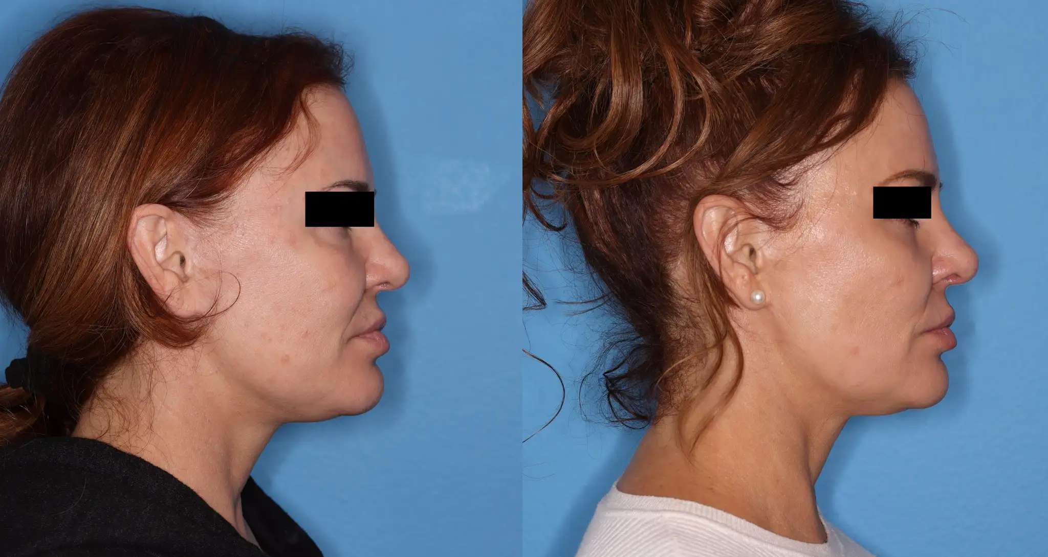 Before and after profile views of a woman showcasing a cosmetic procedure. The left side displays her appearance prior to the treatment, featuring a darker hairstyle and a neutral expression. The right side shows her after the procedure, with a lighter hairstyle and a more defined facial contour. Both images are set against a solid blue background, highlighting the changes in her profile. This visual comparison serves to illustrate the effects of cosmetic enhancement, emphasizing the transformation in facial features and overall aesthetic.