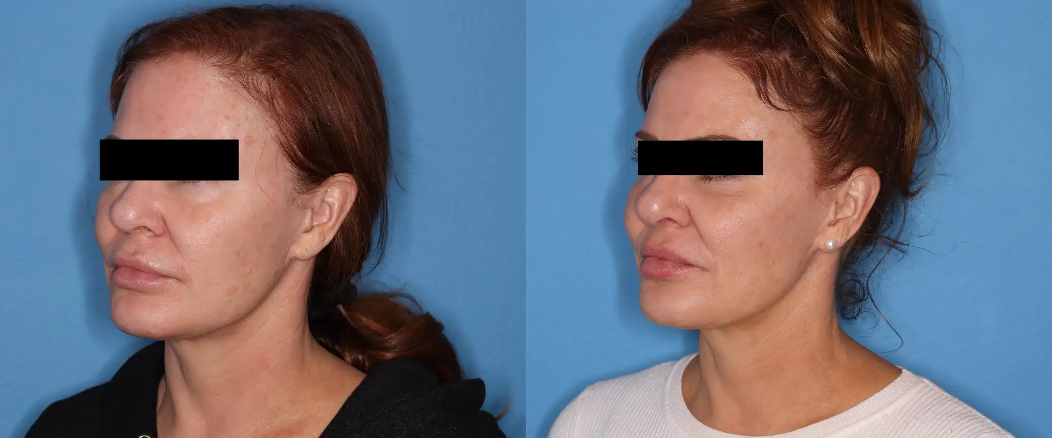 Before and after profile views of a female patient showcasing cosmetic facial enhancements. The left side displays the patient with a natural appearance, while the right side highlights the results post-procedure, emphasizing improved facial contours and skin texture. The background is a solid blue, providing contrast to the subject's features. This image illustrates the effectiveness of cosmetic treatments in enhancing facial aesthetics.