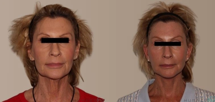 Before and after photos of a woman showcasing the results of a cosmetic procedure. The left image displays her appearance prior to treatment, highlighting signs of aging, while the right image shows her post-treatment, illustrating a smoother complexion and more youthful look. The background is neutral to emphasize the subject's facial features and the changes made. These images are often used to demonstrate the effectiveness of cosmetic enhancements in anti-aging treatments.