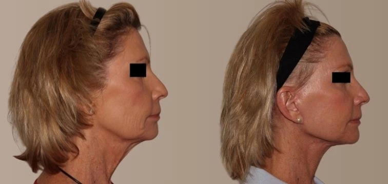 Profile view of a woman showing before and after results of a cosmetic procedure. The image highlights changes in facial contours, with a focus on the jawline and neck area. The left side displays the original profile, while the right side illustrates the enhanced appearance post-procedure, emphasizing improved symmetry and definition. This visual representation is commonly used in aesthetic consultations to demonstrate potential outcomes of cosmetic treatments.