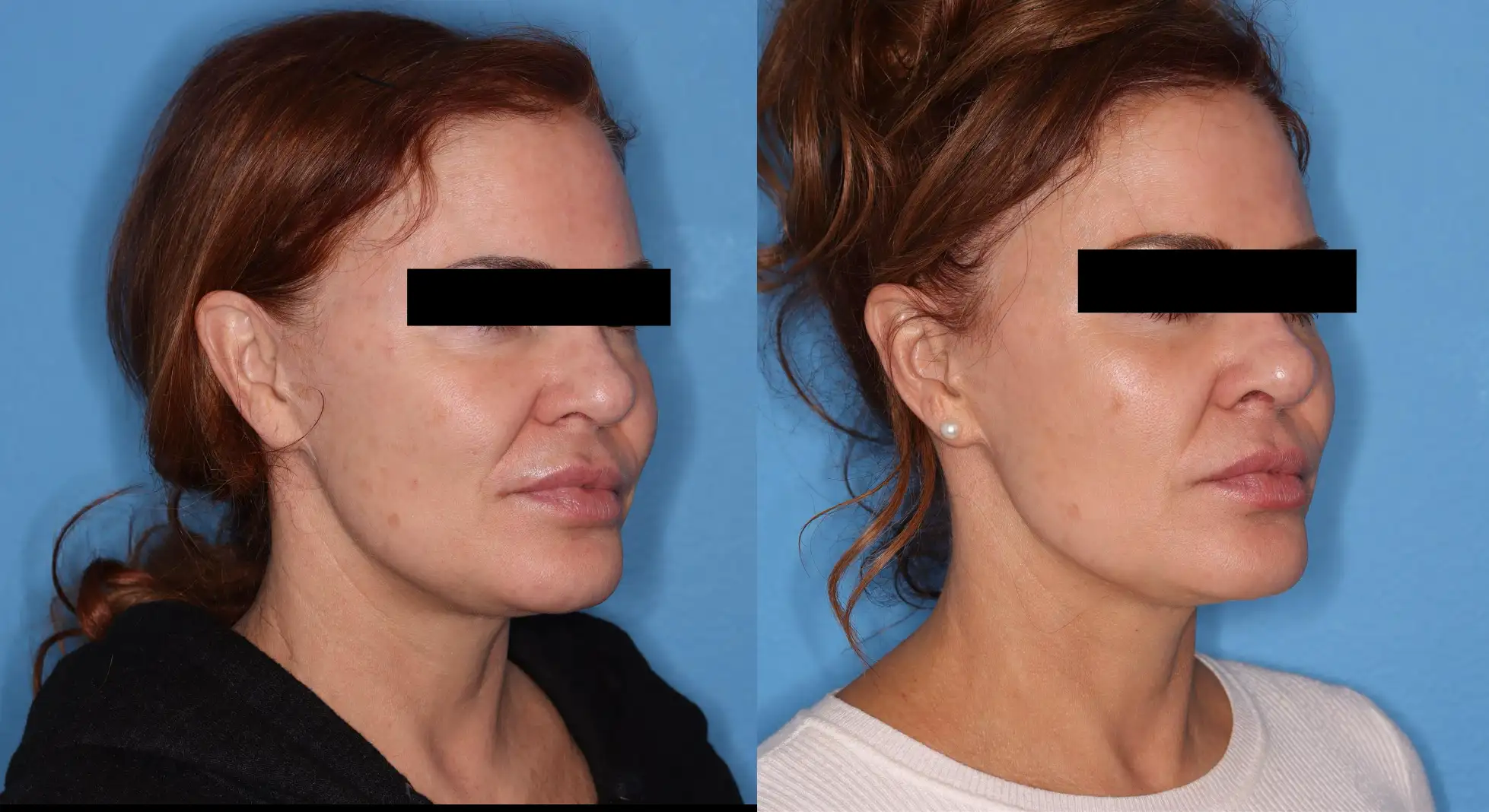 Before and after profile comparison of a woman showcasing facial rejuvenation results. The left side displays her appearance prior to treatment, highlighting features such as skin texture and contour. The right side illustrates the enhanced look post-treatment, with smoother skin and a more defined jawline. The background is a solid blue, providing a clear contrast to emphasize the changes in her facial structure. This image is relevant for discussions on cosmetic procedures and their effectiveness in aesthetic enhancements.
