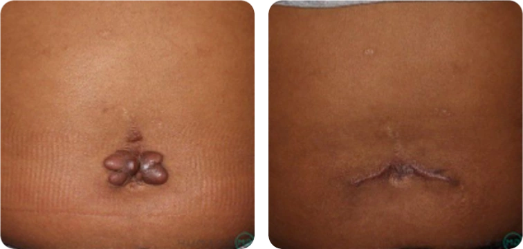 Image depicting a before-and-after comparison of a skin condition on the abdomen. The left side shows a prominent growth, while the right side illustrates the area after treatment, revealing smoother skin with minimal scarring. This image highlights the effectiveness of medical interventions in improving skin appearance and addresses concerns related to dermatological health.