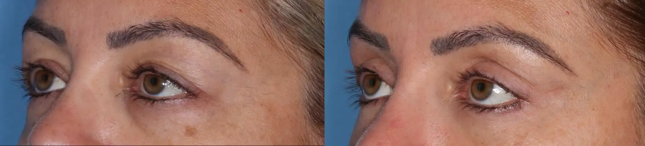 Before and after images showcasing the effects of a cosmetic procedure on facial features. The left side displays a close-up of a forehead with visible signs of aging, including fine lines and wrinkles. The right side presents a close-up of an eye with smooth skin, enhanced eyelashes, and a more youthful appearance. The background is a solid blue, highlighting the differences in skin texture and overall aesthetic improvement. This image illustrates the potential benefits of cosmetic treatments aimed at rejuvenating facial features.