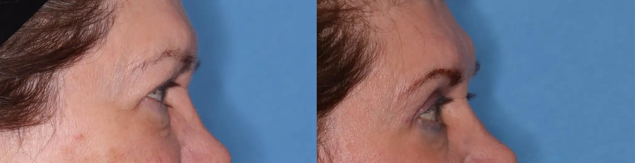 Close-up of a person's scalp showing fine hair texture against a solid blue background. The image highlights the natural color and detail of the hair, emphasizing its health and appearance. Ideal for discussions on hair care, styling techniques, or dermatological topics.