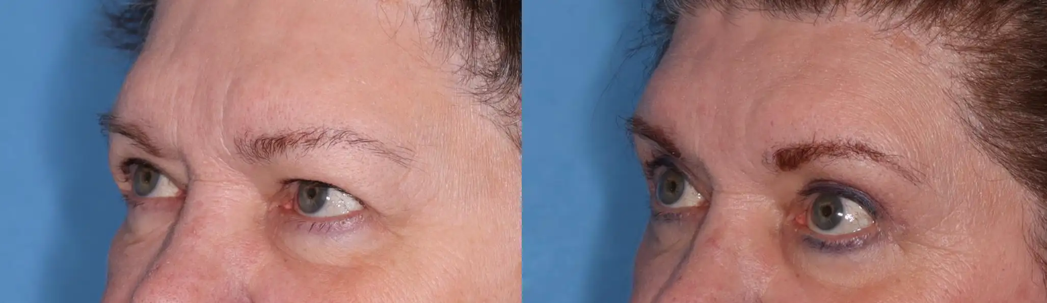 Close-up image comparing two female faces, highlighting the skin texture and eye details. The left side shows a smoother complexion with minimal wrinkles, while the right side features more pronounced lines and a textured appearance. Both faces are set against a blue background, emphasizing the differences in skin condition and overall facial features. This image illustrates the effects of aging on skin and can be used for discussions related to skincare, dermatology, or beauty treatments.