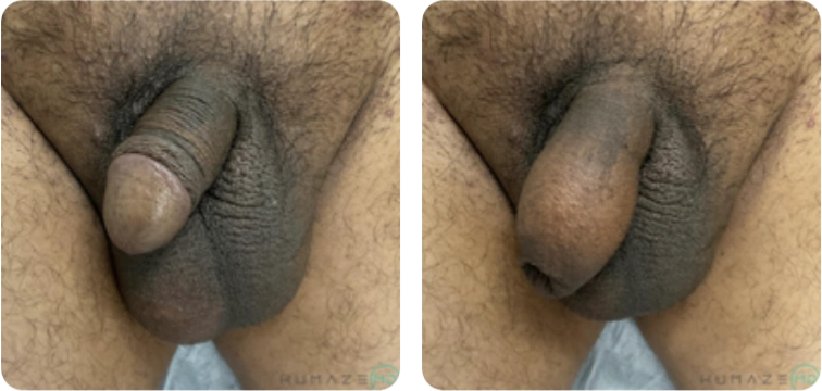 Image depicting two close-up views of skin texture on a human body, focusing on areas with hair and varying skin tones. The left side shows a more textured surface, while the right side presents a smoother appearance. This image can be used to discuss topics related to dermatology, skin care, or body hair variations.