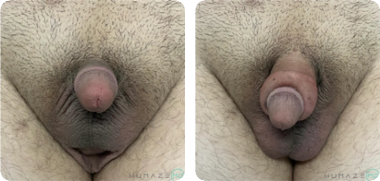 Male girth enhancement before and after results showing improved penile thickness and natural appearance following a nonsurgical cosmetic procedure, used for educational and patient resource purposes.