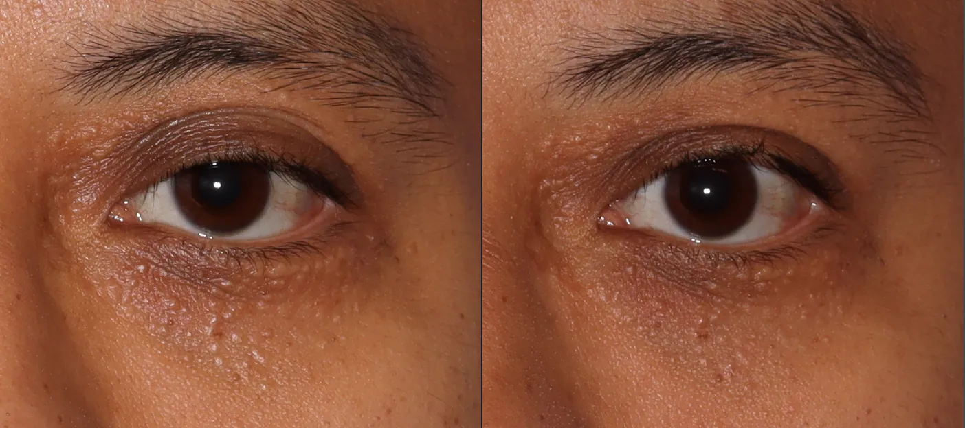 Close-up image showing the eyes of a person, with a focus on skin texture and appearance. The left eye displays signs of dryness and fine lines, while the right eye appears smoother and more hydrated. The image highlights the differences in skin condition around the eyes, emphasizing the importance of skincare. Ideal for discussions on eye care, skincare routines, or treatments for dry skin and aging.