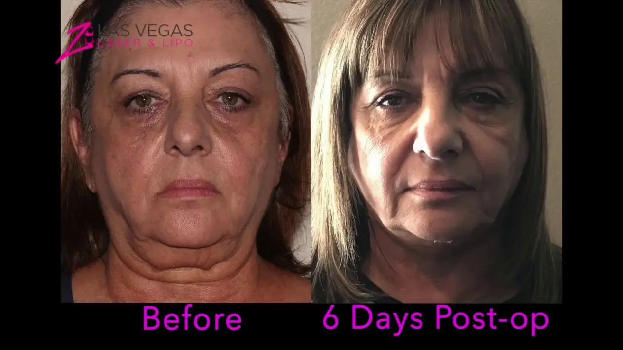 J-Plasma After Sub-Mental Liposuction