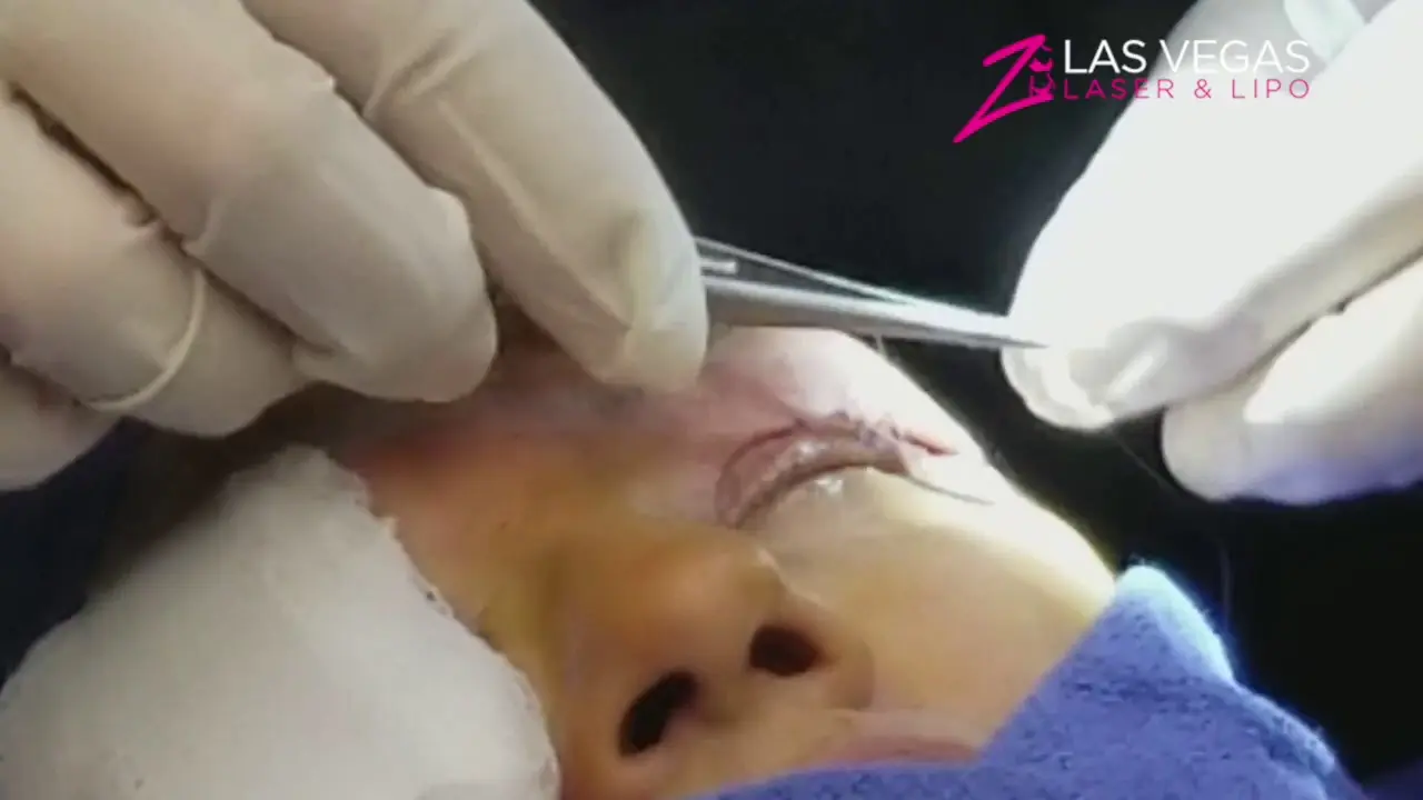Upper Eyelid Blepharoplasty