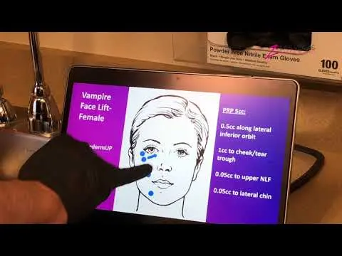 Vampire Facelift