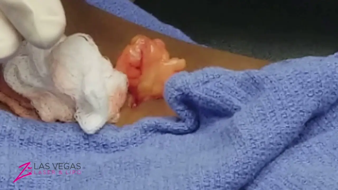 lipoma removal-image
