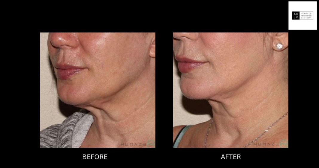 Image comparison showcasing a woman's profile before and after a cosmetic procedure. The left side displays the 